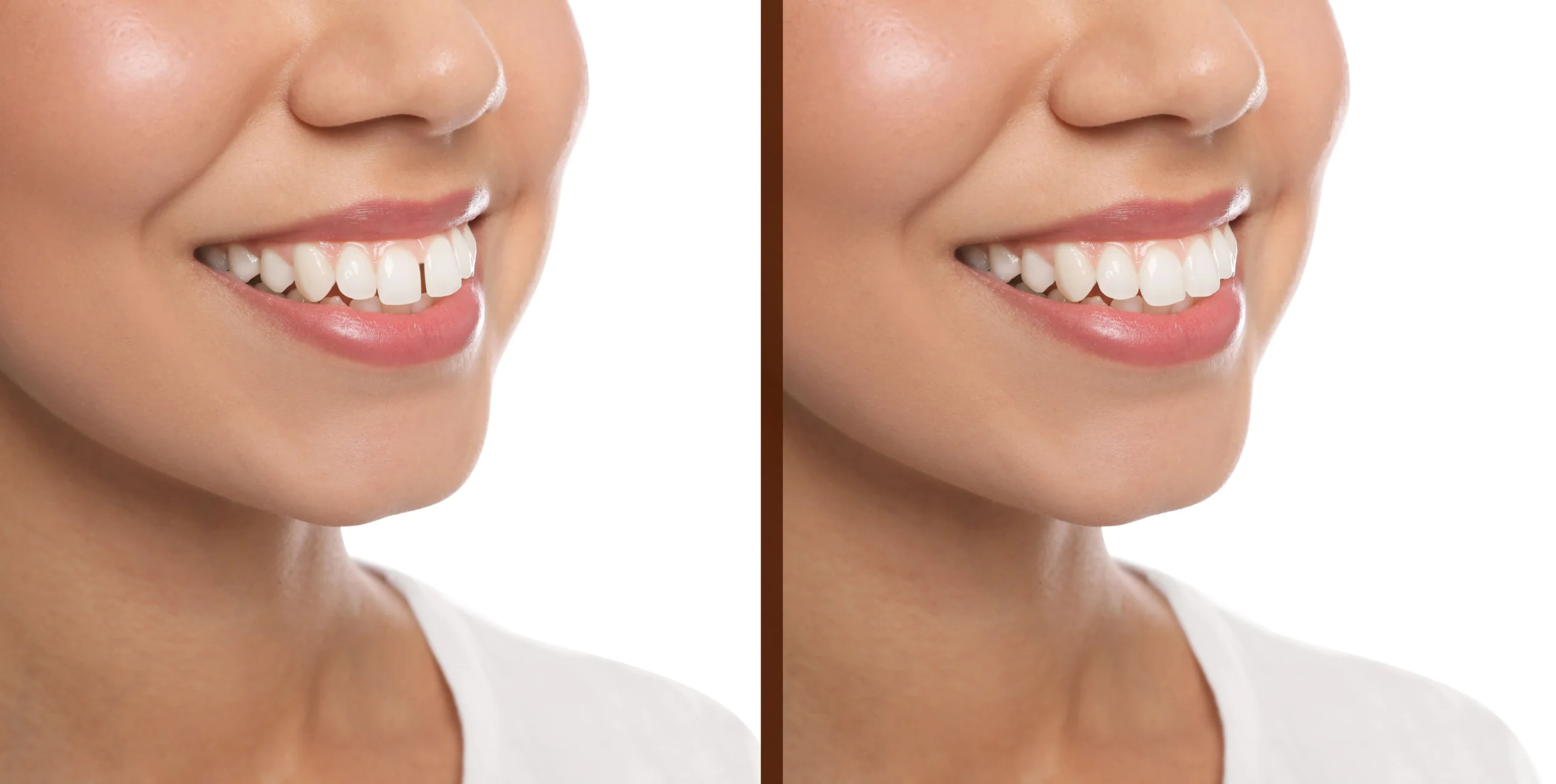 Vertical split screen. Left shows a smile with gaps between teeth while the right shows a gap-free smile.