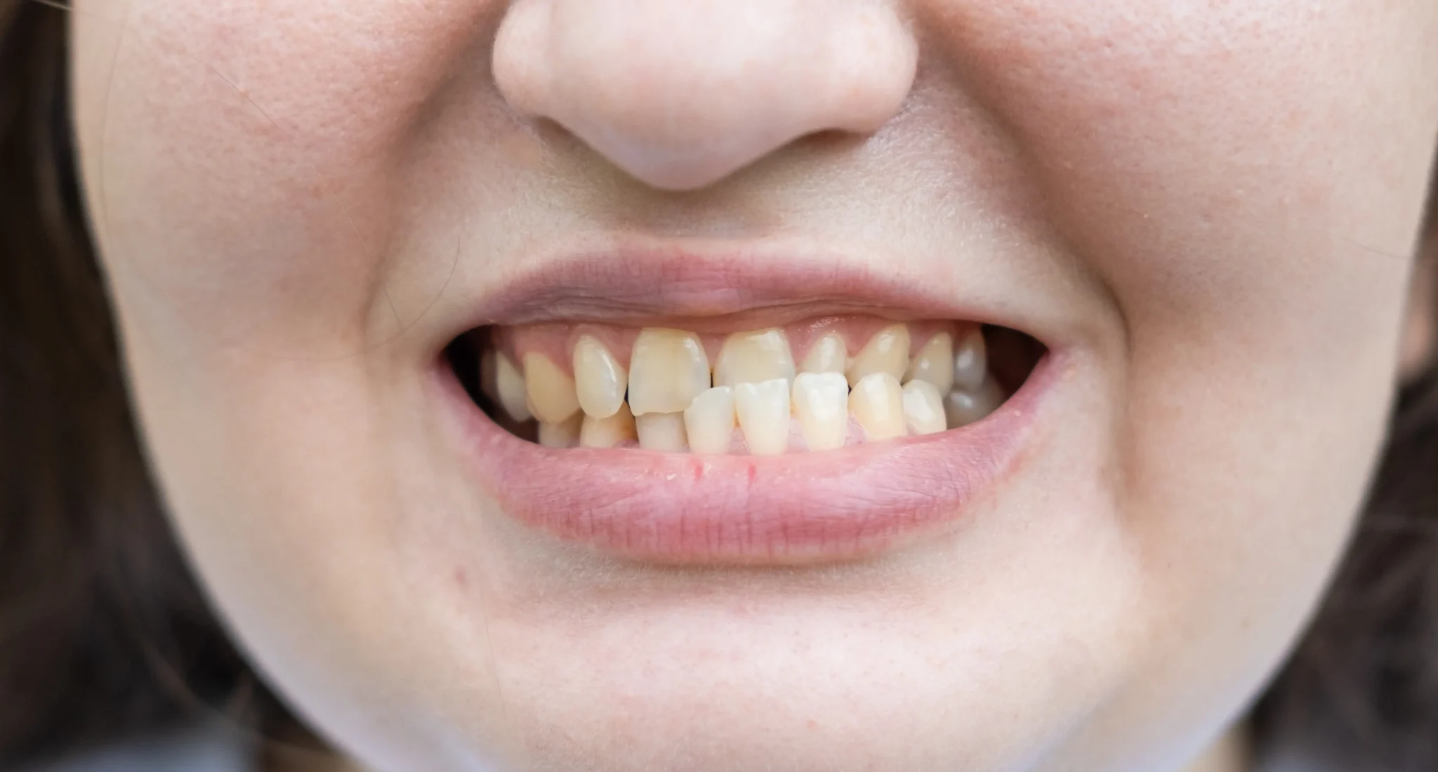 Underbite Fix