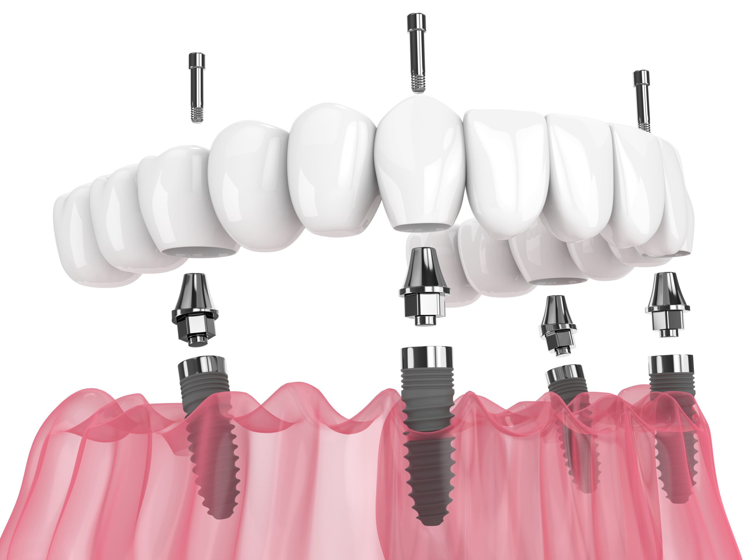 All-on-4 Dental Implant System